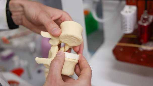 Биомеханики рассчитали нагрузку винтов на позвоночник для лечения детского сколиоза